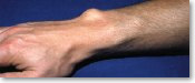 photo handchirurgie ganglion
